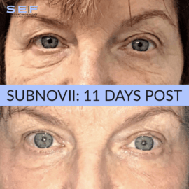 Subnovii Before and After