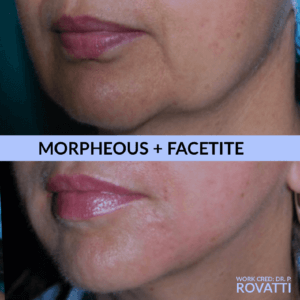 Morpheous and Facetite before and after
