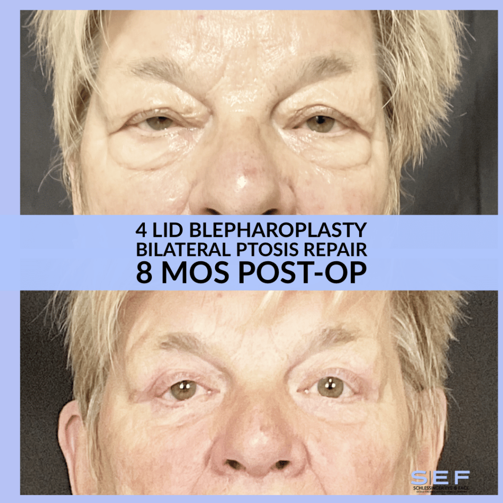 Blepharoplasty Before and After