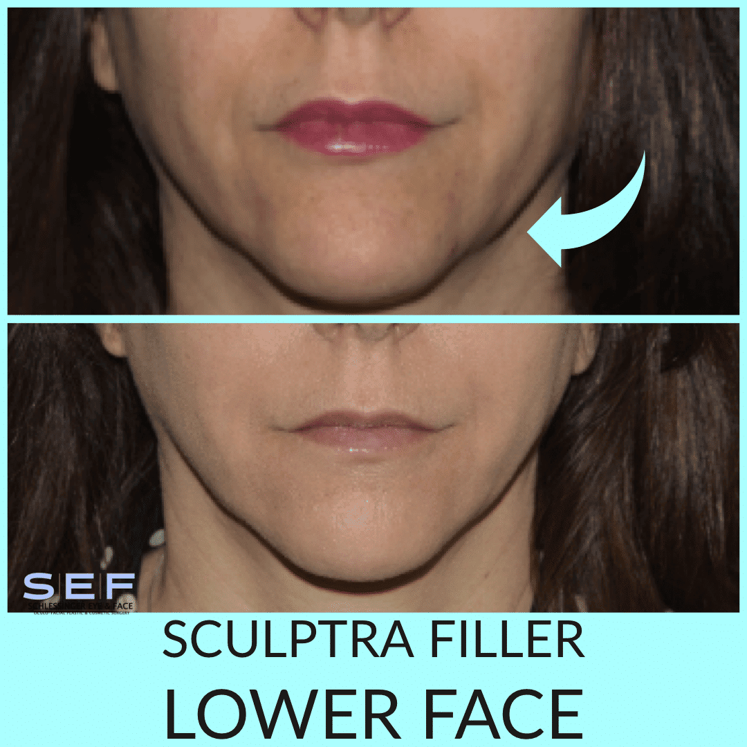 Dermal Fillers Long Island Juvederm Long Island Schlessinger