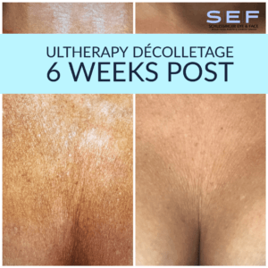 Ultherapy Before and After
