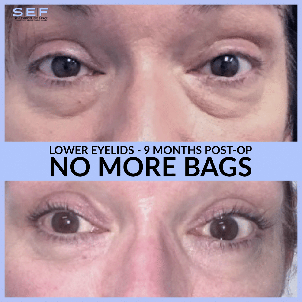 Lower Lid Blepharoplasty before and after