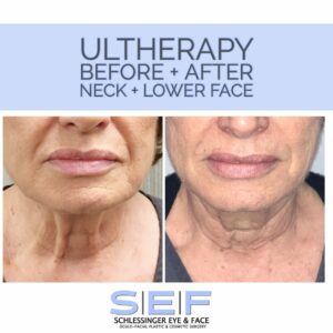 Ultherapy Before and After