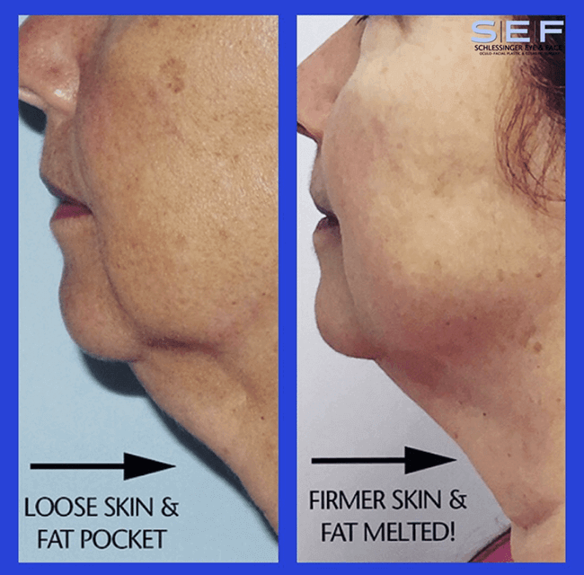 Kybella Before and After