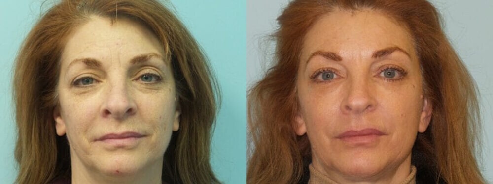 Full Face CO2 Laser Before and After