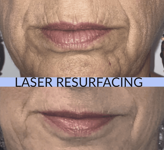 Laser Resurfacing Before and After