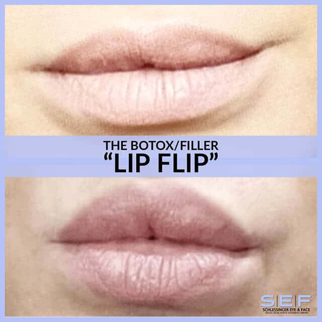 Lip Flip Before and After