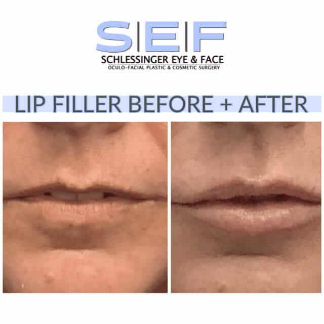 Lip Filler Before and After