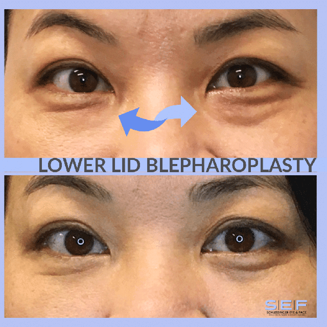 Lower Lid Blepharoplasty Before and After