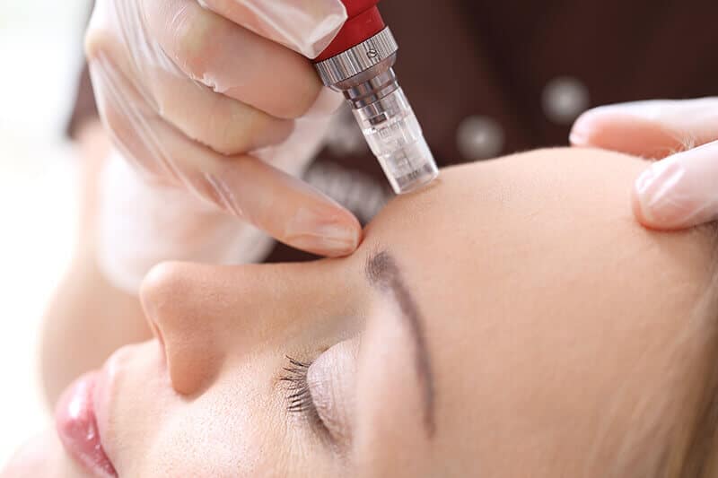 Microneedling treatment