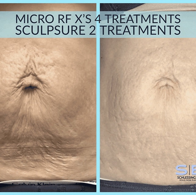 Micro RF & Sculpsure Before and After