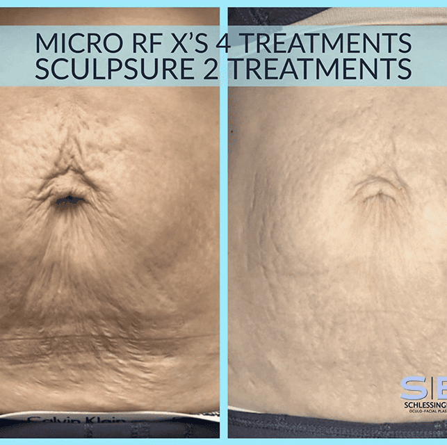 Microneedling Before and After