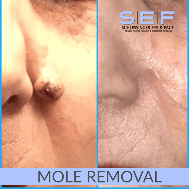 Mole & Cyst Removal Before and After