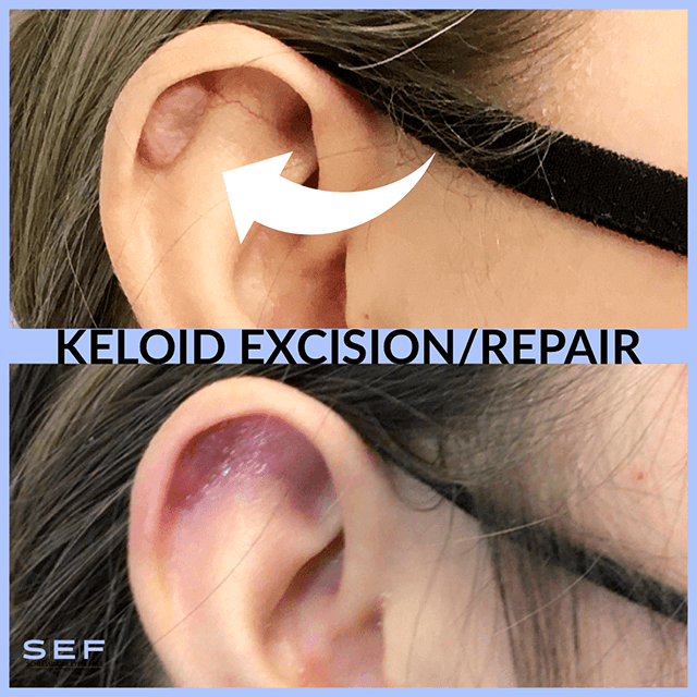 Mole & Cyst Removal Before & After