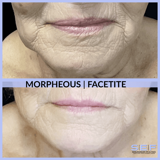 Morpheous8 and Facetite Before and After