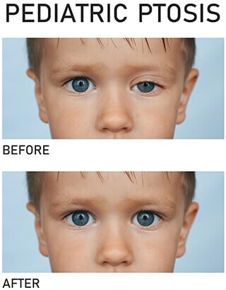 Pediatric Ptosis before and after