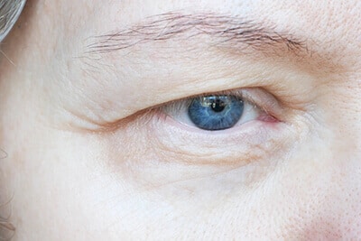 Ptosis droopy eyelid
