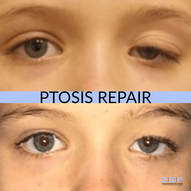 Ptosis Repair Before & After