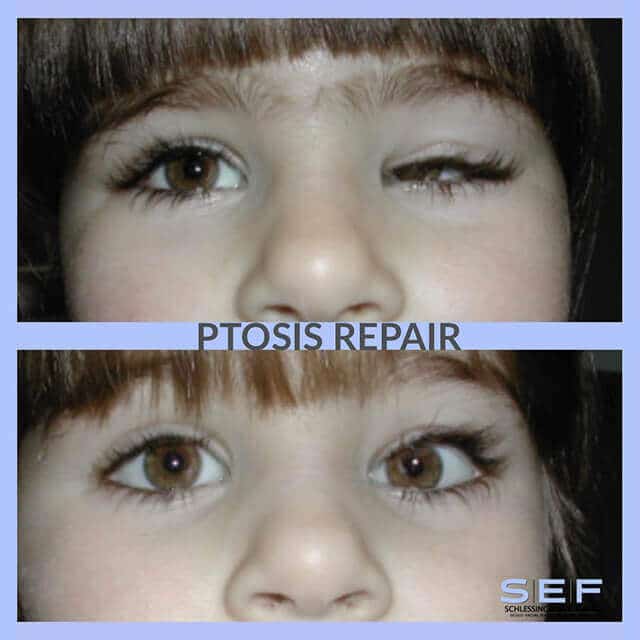 Ptosis Repair Before & After