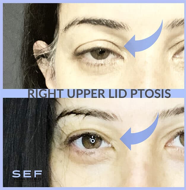 Right Upper Lid Ptosis Before and After