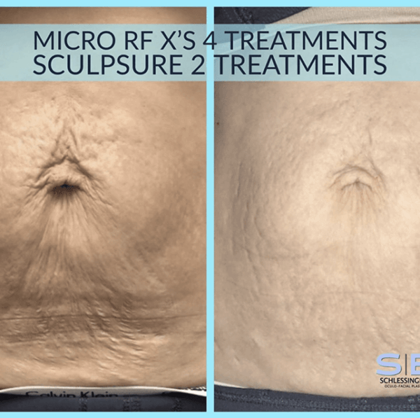 Sculpsure Before & After Gallery Schlessinger Eye & Face Woodbury, NY