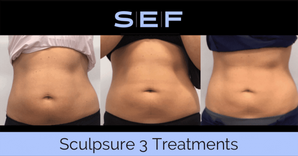 SculpSure Before and After