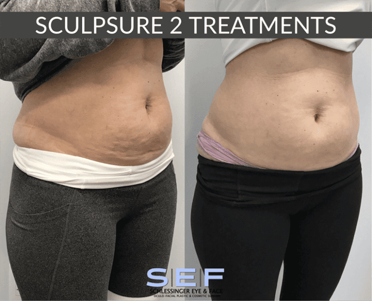 Sculpsure Before & After Gallery Schlessinger Eye & Face Woodbury, NY