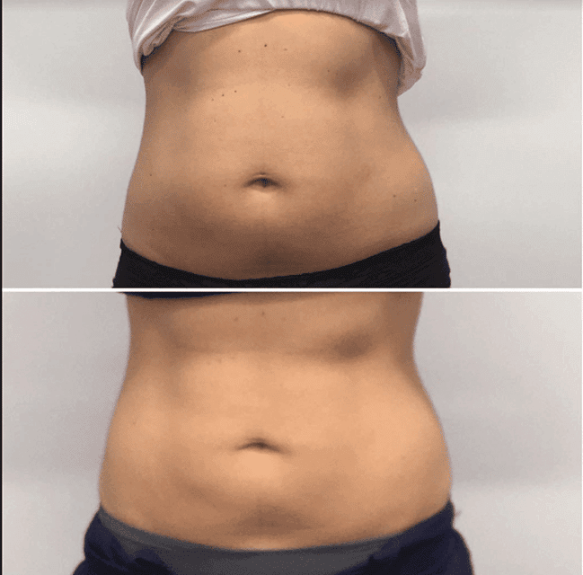 SculpSure Before and After