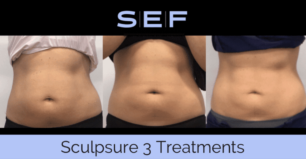 SculpSure before and after