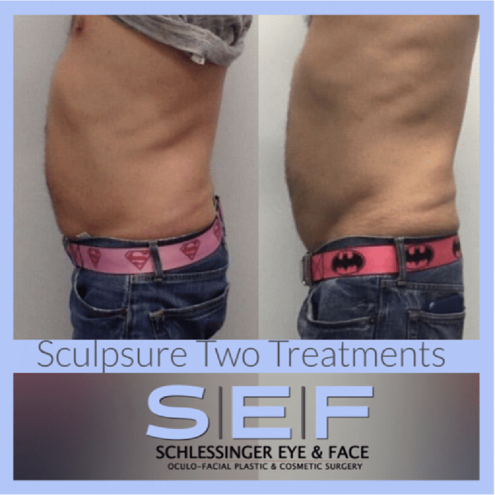 SculpSure Before and After