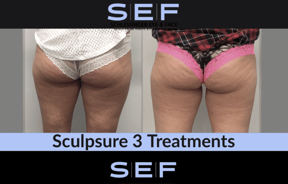 SculpSure before and after