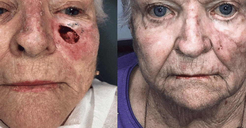Skin Cancer Reconstruction Before and After