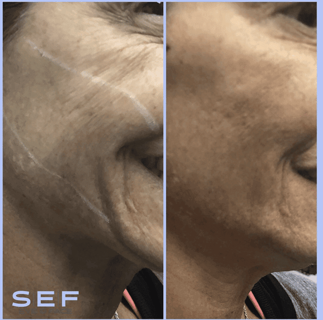 Thread Lift Before and After