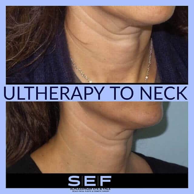 Ultherapy Before and After