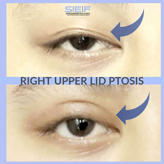 Right Upper Lid Ptosis