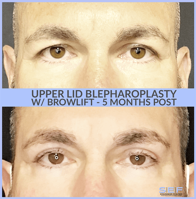Upper Lid Blepharoplasty with Browlift